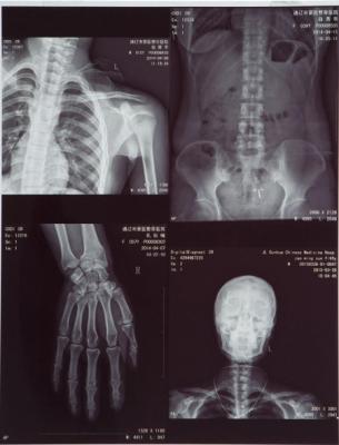 High-clarity Medical X Ray Film FUJI DIHT 14*17in Laser Dry Imaging Film