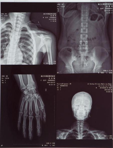 High-clarity Medical X Ray Film FUJI DIHT 14*17in Laser Dry Imaging Film
