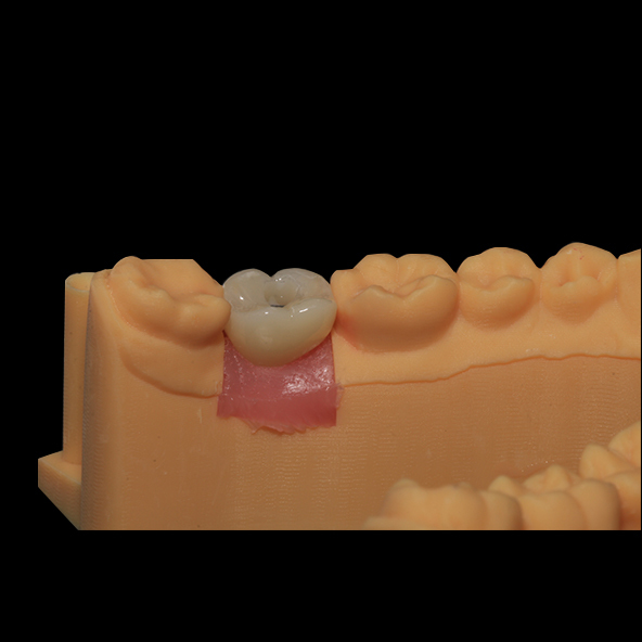 Silver Custom Titanium Abutments Dental Implants With Full Zirconia Crown