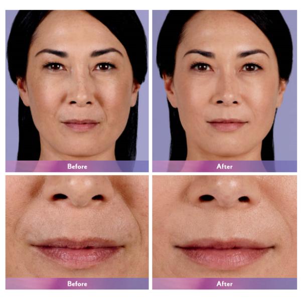 Заполнитель Juvederm Voluma впрыски соединенный крестом дермальный