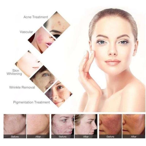 OPT SHR Epilation IPL Laser Hair Removal Machine 2000W 1-10Hz