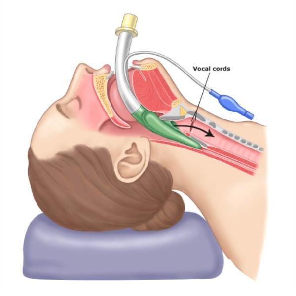 ICU Use Latex-Free Medical Supply Double Tube Standard Silicone Laryngeal Mask Airway  #2-5# Size With CE ISO13485
