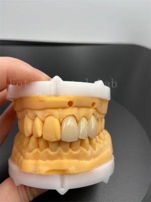 Precision Fit Digital Crowns Implant Dentrues With Compatibility Email Transmission Mode