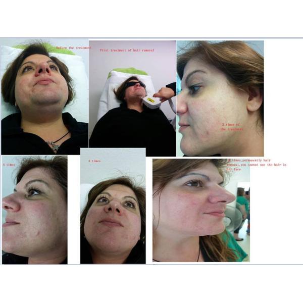 depilation laser hair removal laser Diode laser hair removal,quickly and painless for all skin type,Factory price