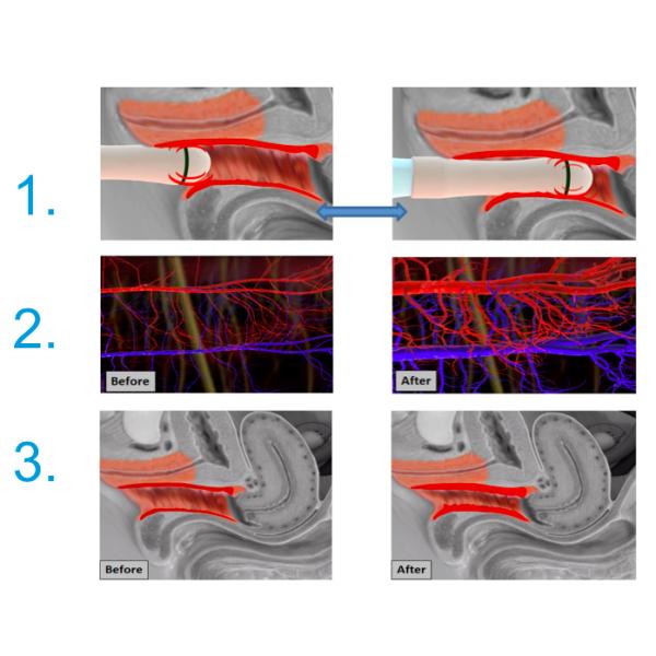 Ultra Femme 360°  female intimate areal Rejuvenation, Virgin-Tightening and Improvement of Sex ual Function