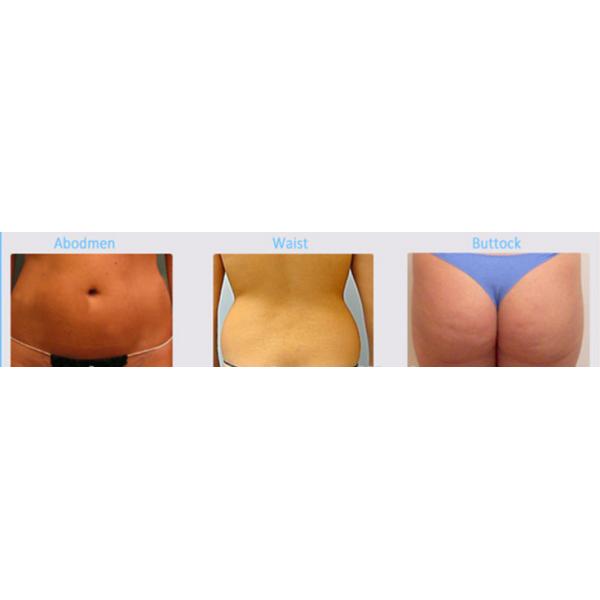 Skin tightening U Shape focused ultrasound slimming machine with CE Approved