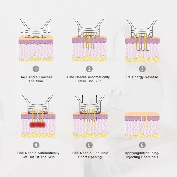 Fractional Professional RF Skin Tightening Microneedling Machine For Face Lifting China Beauty Machine Factory