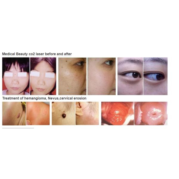 Хирургическая лазерная машина СО2 15 Вт для удаления шрамов и удаления пигмента