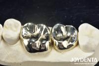 Wax Casting Dental Repair Full Metal Crown For Abrasion Resistant Oral Rehabilitation