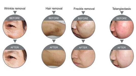 High power IPL hair removal equipment and improve skin elasticity and glossiness