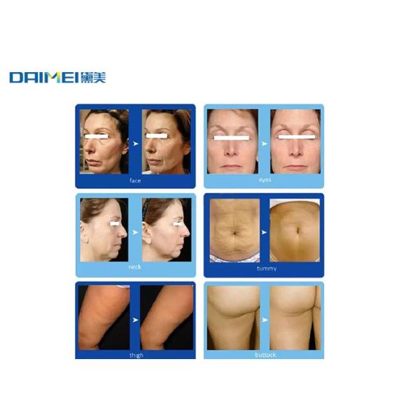 Vertical High Intensity Focused Ultrasound Machine RF Electromagnetic BTL Body Sculpture