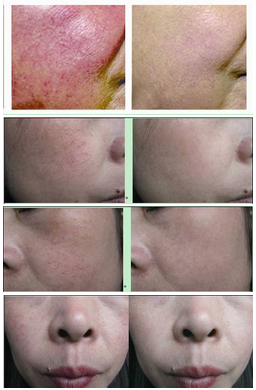 Salon use spider vein removal machine for blood Vessel Removal on face, leg