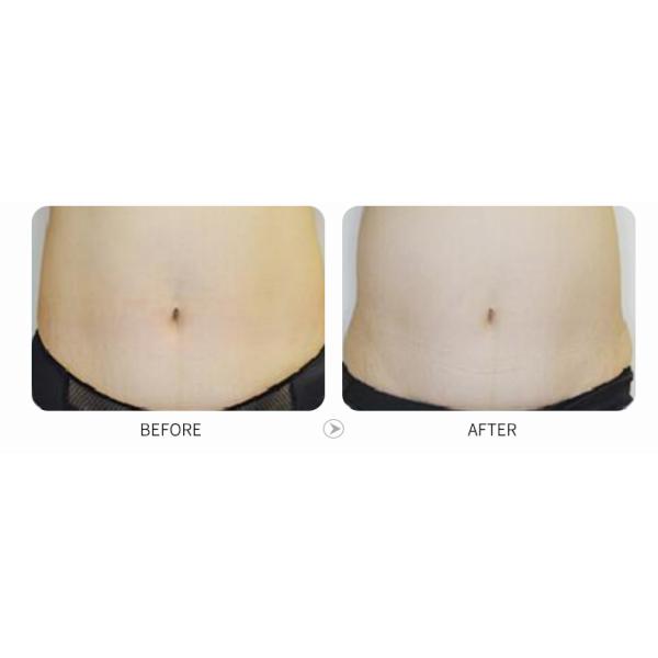 Home Use Mini Cryo Fat Freezing Weight Loss Equipment