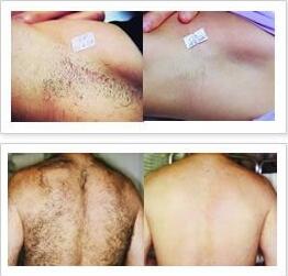 Безболезненный E Light профессиональный эпилятор с сенсорным экраном