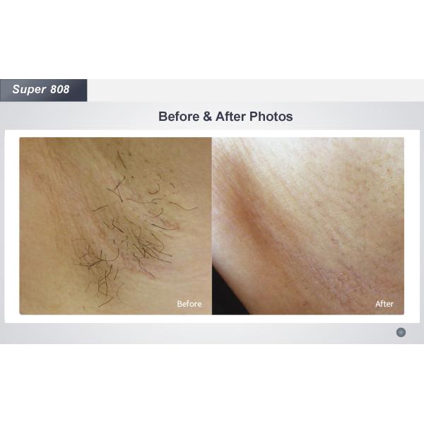 808nm 1064nm Commercial Laser Hair Removal Machine 755nm