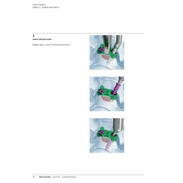 Sterilization 2 Screws Zero Profile Cage Anterior Cervical Cage Stand Alone CE Spinal Surgery