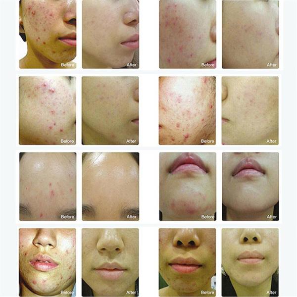 Photon Professional Led Light Therapy Machine Anti Wrinkle Skin Rejuvenation