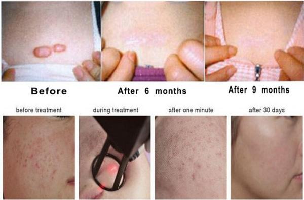 1-100ms Pulse Width Fractional Carbon Dioxide Laser With Wind Cooling System