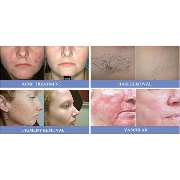 Salon Beauty Facial Hair Removal Devices 1000W - 3000W Power Water Flow Safety Control