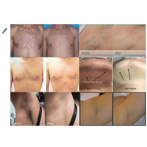 2000w Pain Free Laser Hair Removal Machines Laser Depilation Equipment