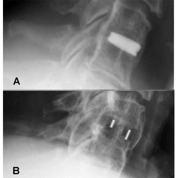 Orthopedic Peek Cage Cervical , Lumbar Cage Interbody Fusion Device