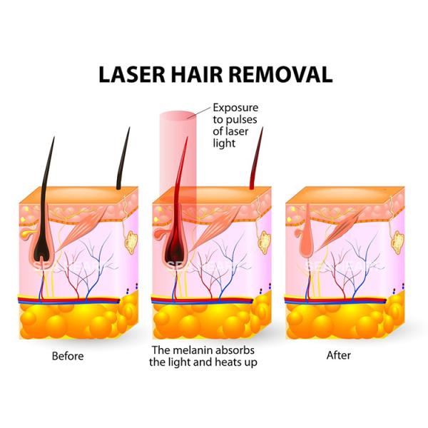 10hz Nochannel Diode Laser Machine For Hair Removal
