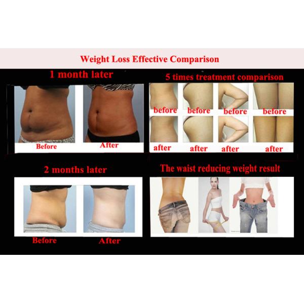 cryo services vaser liposelection cost of laser liposuction procedure 15 inch screen -15Celsius