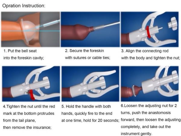 Boys Surgical Disposable Circumcision Stapler Suture Anastomat Device