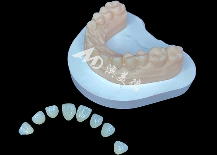 IPS e.max Veneer Премиум эстетическое решение для потрясающих трансформаций улыбки