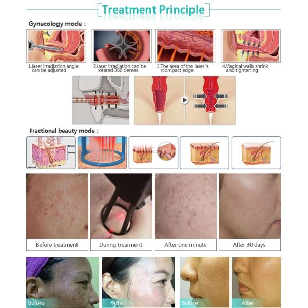 Nubway Best Professional Medical RF Fractional CO2 Laser. Best Professional Medical RF Fractional CO2 Laser