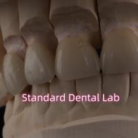 Laboratorio Dental Profesional Corona de zirconia para restauración fija