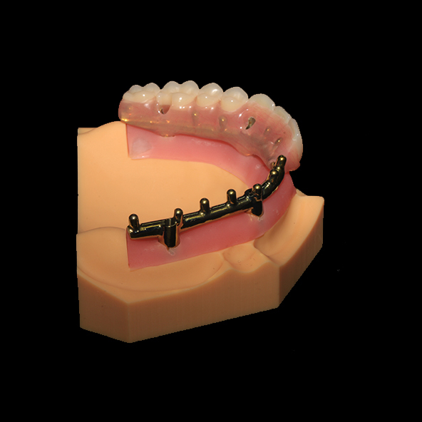 Dental Implant Laboratory | Class 3 Milled Titanium Bar All On X Dental Lmplants With Full Acrylic Denture