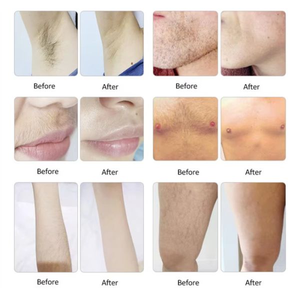 Effective 1200W-1600W Hair Removal Epilator 808nm Diode Laser Machine