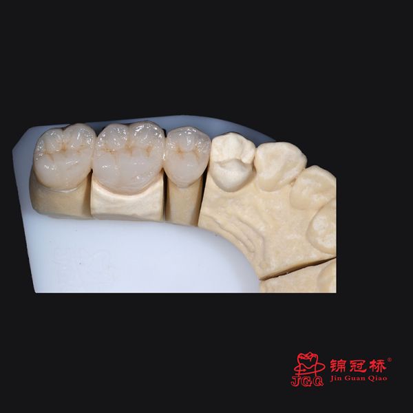 China Dental Artificial Teeth Pfm Dental Metal Ceramic Crown Bridge Customized