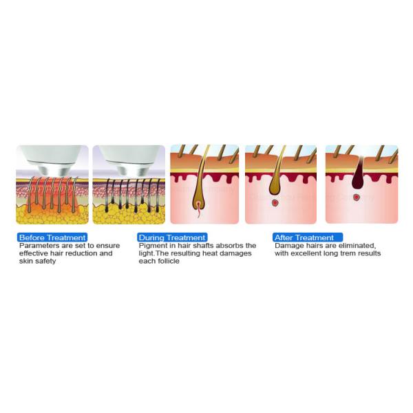 CE Professional Soprano 808nm Diode Laser Epilator , 808nm Diode Laser , 808nm Diode Laser Hair Removal