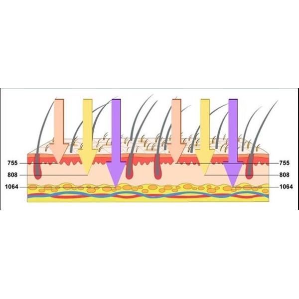 Máquina de depilación láser 755 808nm 1064nm Máquina de láser de diodo para depilación