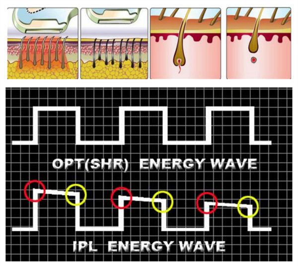 Portable Beauty Equipment Salon Use SHR Hair Removal With SPT / FCA Technology