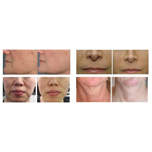 CE Approved HIFU Beauty Machine , Multi - Lines SMASS HIFU Medical Equipment