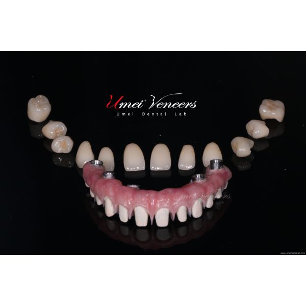 Robust zirconia planted bridges