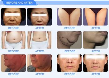 Hifu Machine for Body Face Lifting Tightening Wrinkles Removing Jaw Line Lifting