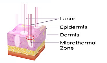 кожа лазера СО2 машина/50В красоты лазера 10600нм частичная Ресурфасинг