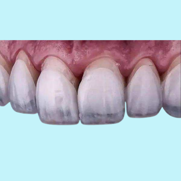Облицовки кроны Zirconia зубоврачебных Dentures облицовок лаборатории зубоврачебных реставраторские
