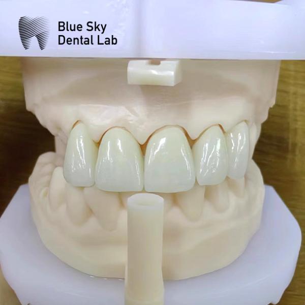 Coroas de zircón en capas de porcelana rosa Coroa dental de zircón para restauraciones estéticas