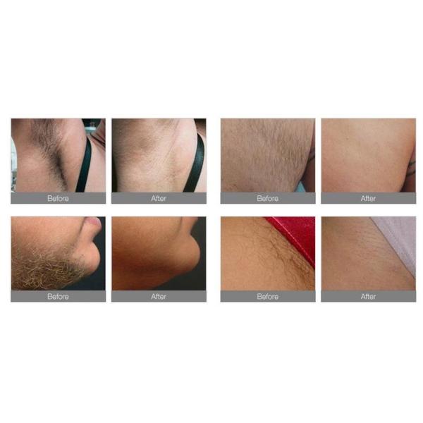 Non Channel 755 808 1064nm Diode Laser Hair Removal Professional Equipment