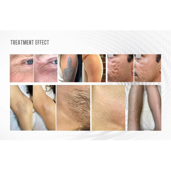 Épilation laser à diode portative 808nm Picosecond Machine d'épilation de tatouage