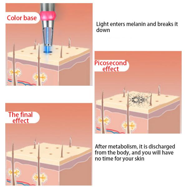 Медицинская переключенная q машина лазера Nd Yag, машина удаления татуировки лазера красоты