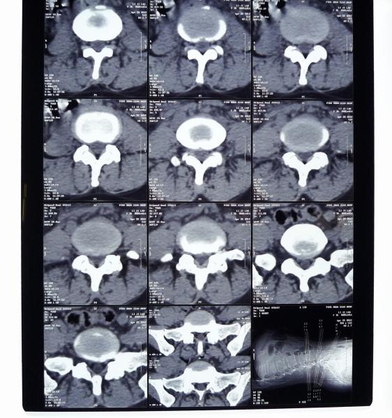 8in* 10in filme seco da impressora térmica do raio X médico high-density de 14in * de 17in