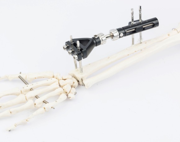 CE / ISO Orthopedic External Fixator Trauma Sterilized Fracture Distal Radius