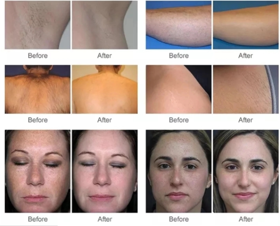 560nm Ipl Skin Rejuvenation Device SHR 2000w For Hair Removal