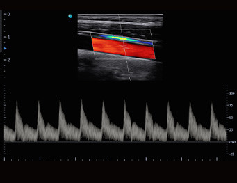 Critical Care 4 Probe Ports Chison Ultrasound Machine SonoAir 60